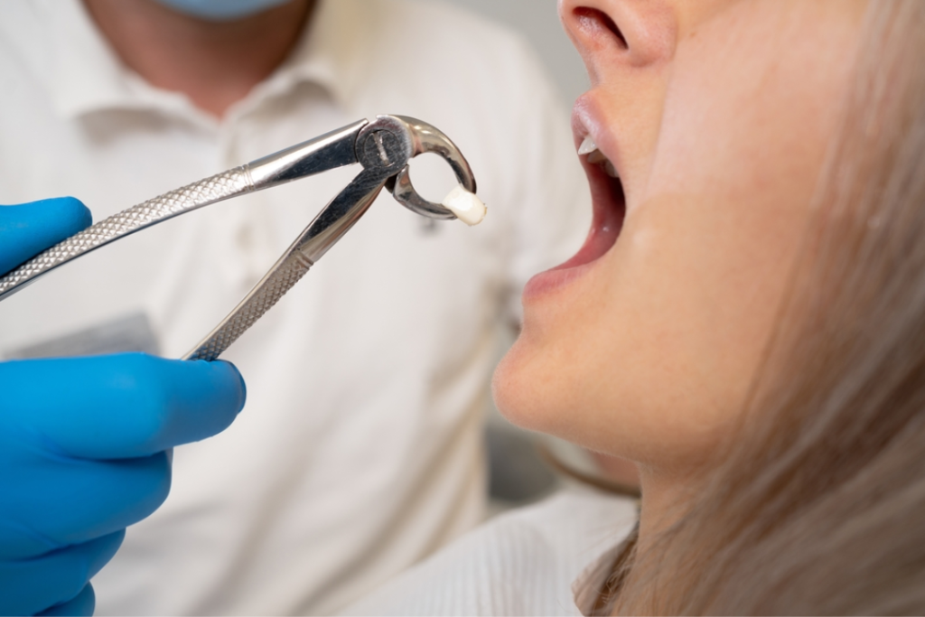 Tooth Extraction & Wisdom Tooth Removal